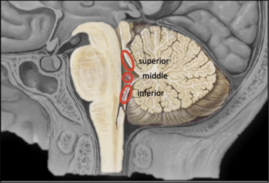 <ul><li><p>Superior Cerebellar Peduncles - <strong>Brachium Conjunctivum</strong></p></li><li><p>Middle Cerebellar Peduncles - <strong>Brachium Pontis</strong></p></li><li><p>Inferior Cerebellar Peduncles - <strong>Restiform Body</strong></p></li></ul><p></p>