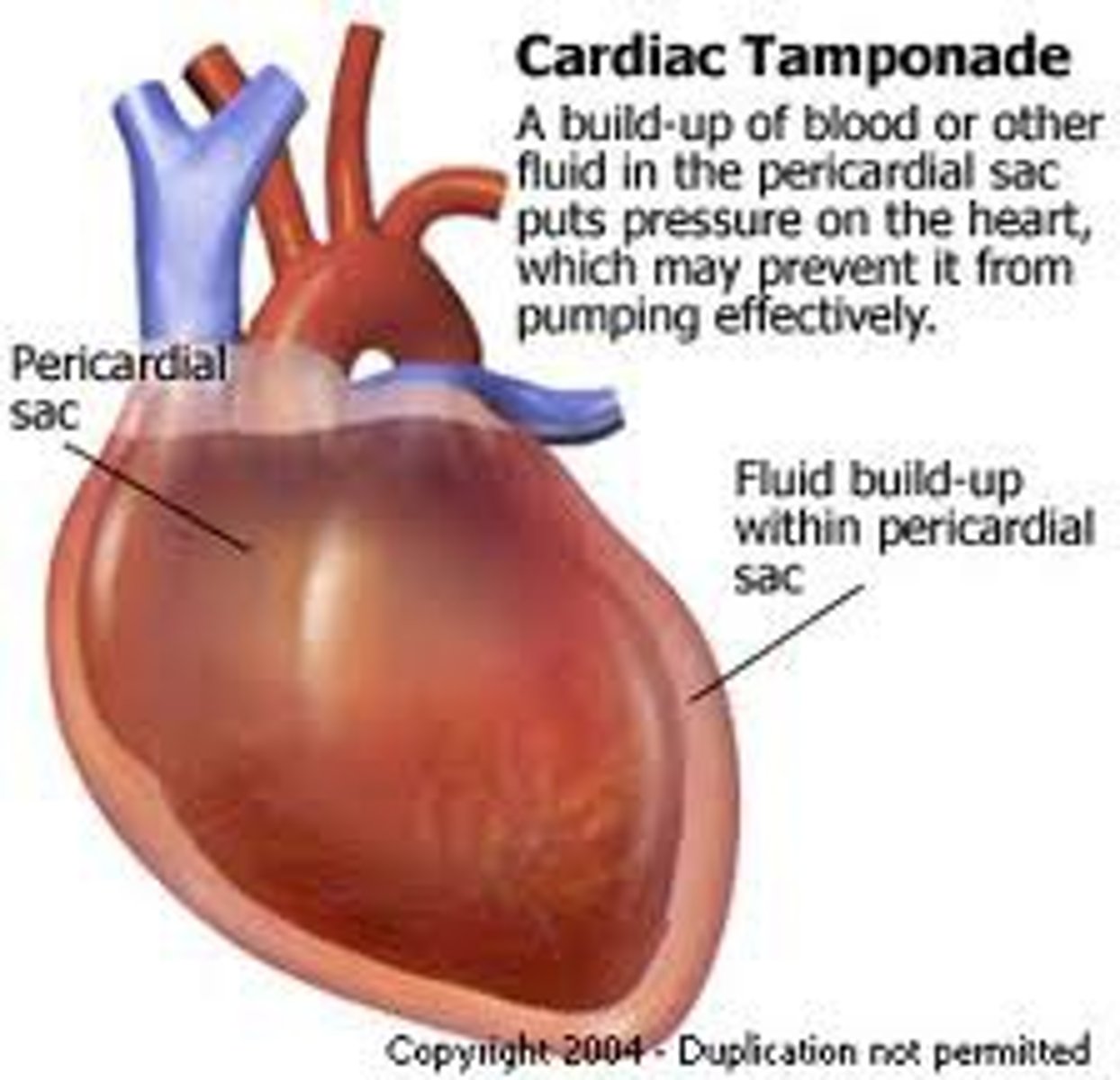 <p>acute compression of the heart caused by fluid accumulation in the pericardial cavity</p>