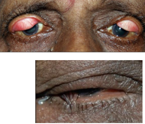 <p>Type of <strong>pseudoptosis</strong> characterized by a decrease in elastin of eyelid skin and/or tarsal plate</p><ul><li><p>Easy superior lid eversion</p><ul><li><p>Papillary conjunctivitis</p></li><li><p>Ropy discharge</p></li></ul></li><li><p>Poor apposition to ocular surface</p></li><li><p>Association with sleep position if unilateral</p></li><li><p>Lid and lash ptosis</p></li><li><p>Lagophthalmos</p></li><li><p>Abnormal lid position</p></li></ul><p></p>