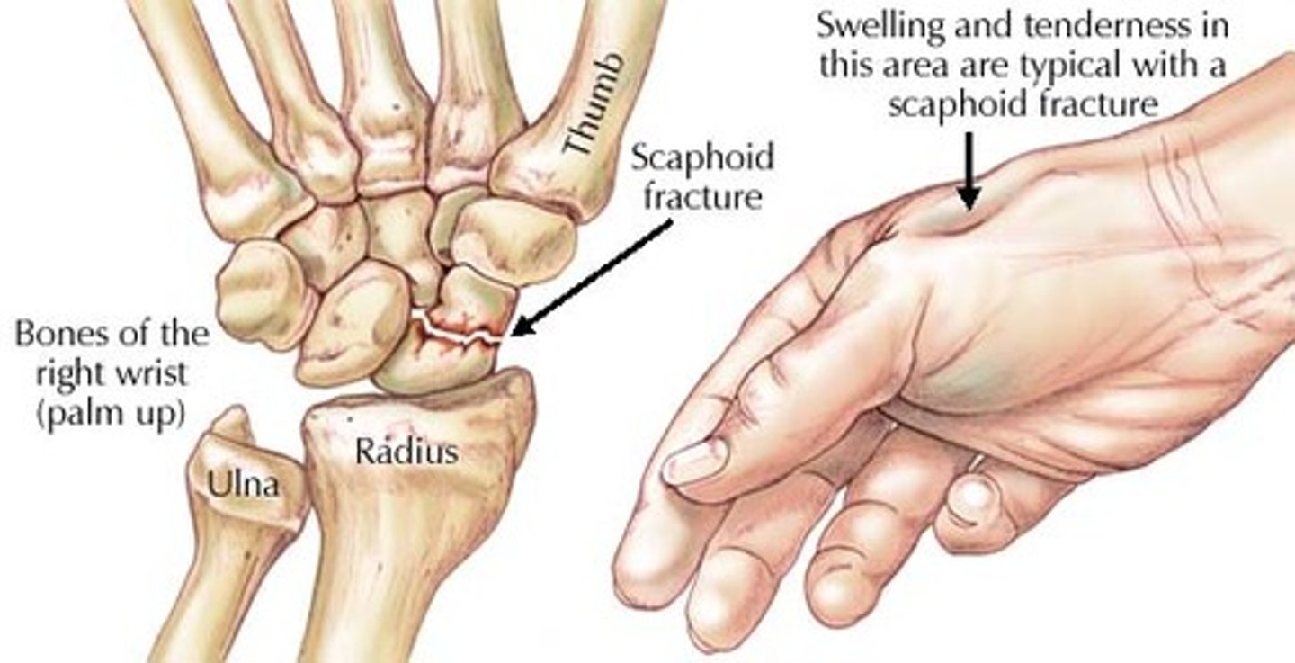 <p>What is the most commonly fractured carpal bone?</p><p>- scaphoid bone</p><p>Where can this bone be palpated (surface anatomy)?</p><p>- palpated in the anatomic snuff box</p><p>How does it get injured?</p><p>- typically from a fall on an outstretched hand</p><p>Any other complications of injury?</p><p>- prone to avascular necrosis due to a retrograde blood supply (the dorsal scaphoid branch of the radial artery supplies the majority of the scaphoid after entering near the bone's distal pole. blood supply to the proximal pole proceeds in a retrograde manner and can be easily interrupted by a fracture)</p><p>- nonunion</p>