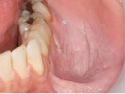 <p>what is the cause of this lesion </p>