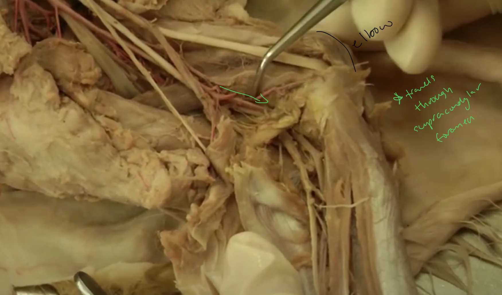 <p>which artery is this?</p>