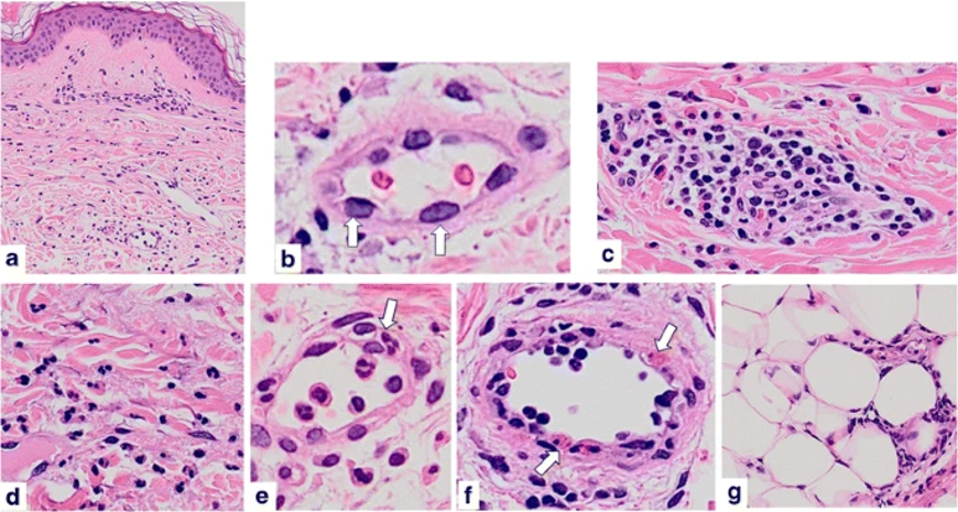 <p>TYPE 1 HYPERSENSITIVITY</p><p>a Dermal edema and perivascular and interstitial inflammatory cell infiltration with minimal epidermal change</p><p>b Dilatation of small vessel and swelling of endothelium (arrows)</p><p>c Perivascular mixed cell infiltrate with lymphocytes, neutrophils, and eosinophils. </p><p>d Interstitial infiltration. Neutrophils are scattered among the collagen bundles</p><p>e Neutrophils are present inside the dilated small vessel. A neutrophil migrates into the vessel wall (arrow) </p><p>f Some eosinophils are attached to and emigrated from the vessel wall (arrow)</p><p>g Subcutaneous cellular infiltration</p>