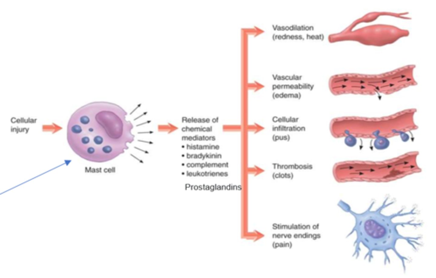 <p>- vasodilation (redness, heat)</p><p>- vascular permeability (edema)</p><p>- cellular infiltration (pus)</p><p>- thrombosis (clots)</p><p>- stimulation of nerve endings (pain)</p>