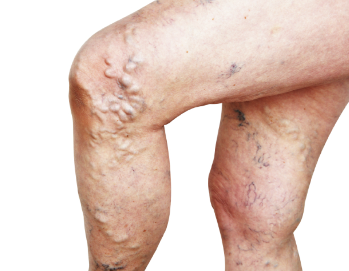 <p>Abnormally swollen, twisted veins with defective valves; most often seen in the legs</p>