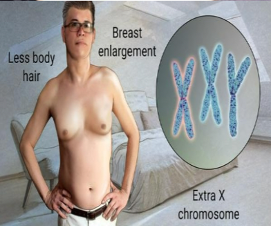 <p>Condition in males with two Xs and one Y</p><ul><li><p>have less body hair and breast enlargement</p></li><li><p>Not sterile but tougher for reproduction</p></li></ul><p></p>
