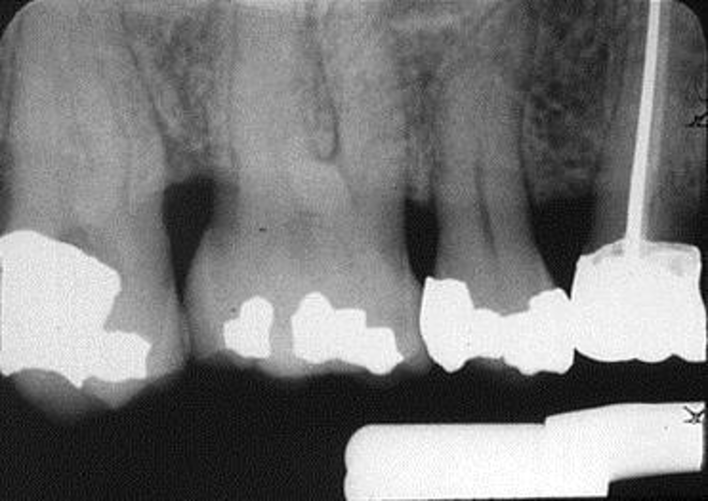 <p>Appearance-Apices "cut off"</p><p>Cause-plate too close to the teeth</p><p>Correction-Make certain the incisal-occlusal surfaces of the teeth touch the bite-block. Position plate in the middle of the oral cavity when working in the maxillary arch</p>