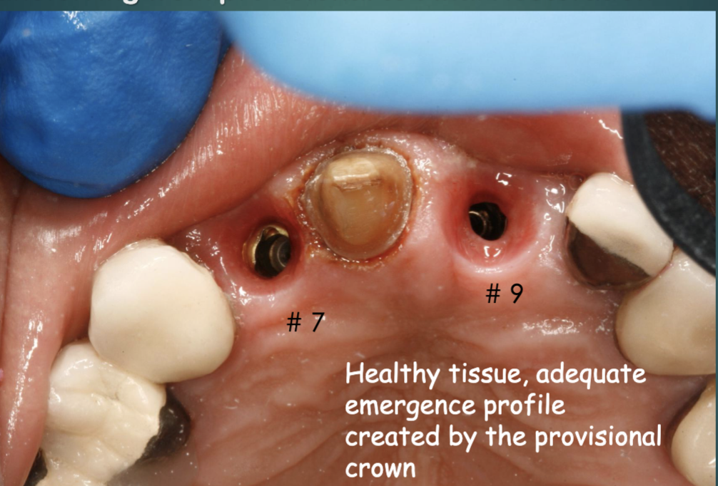 <p>steps for final implant restoration- transferring from provisional to final restoration </p>