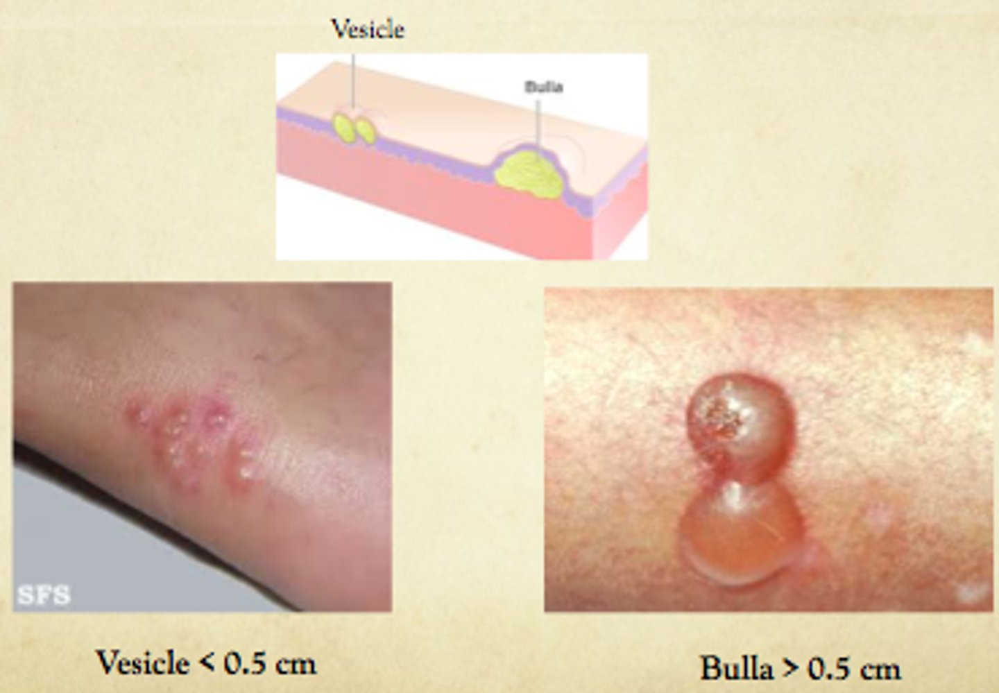 <p>Vesicle: up to 1 cm, elevated, fluid filled (blister, herpes, zoster)</p><p>Bulla: > 1 cm, fluid filled, easily ruptures</p>