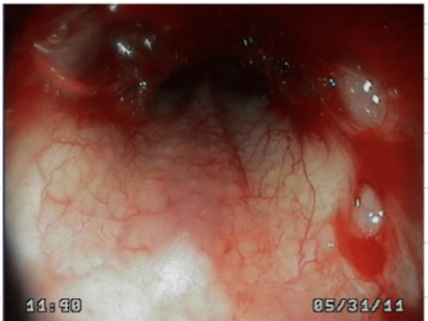 <p>stomach endoscopy. what disorder do we see here?</p>