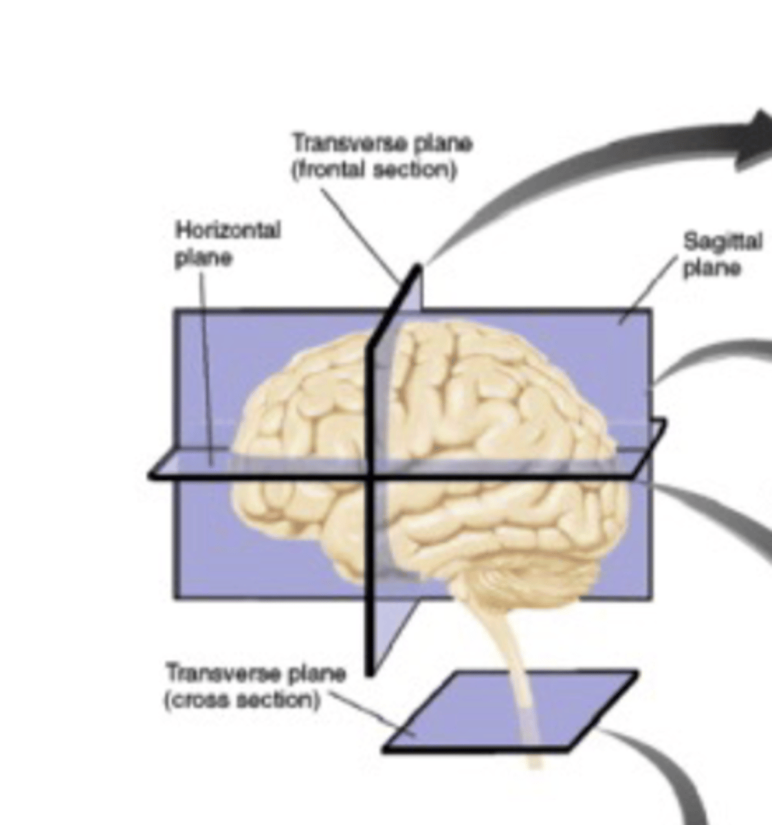 <p>a slice through the brain perpendicular to the ground and parallel to the temporal lobes</p>