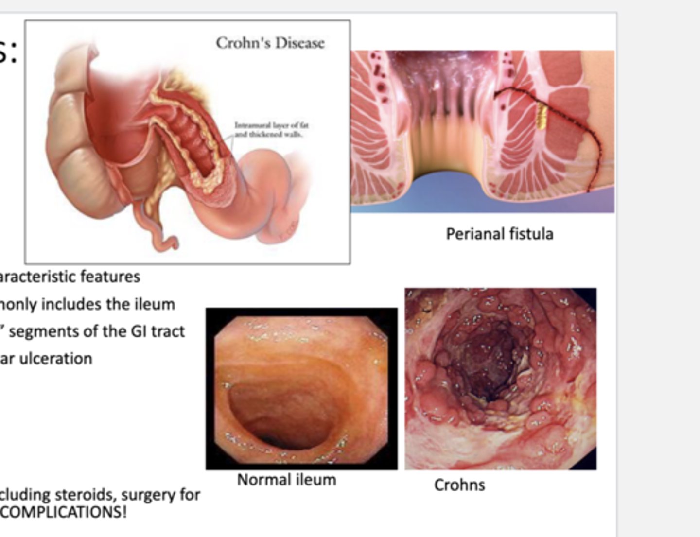 <p>-intestinal obstruction</p><p>-fistulas</p>