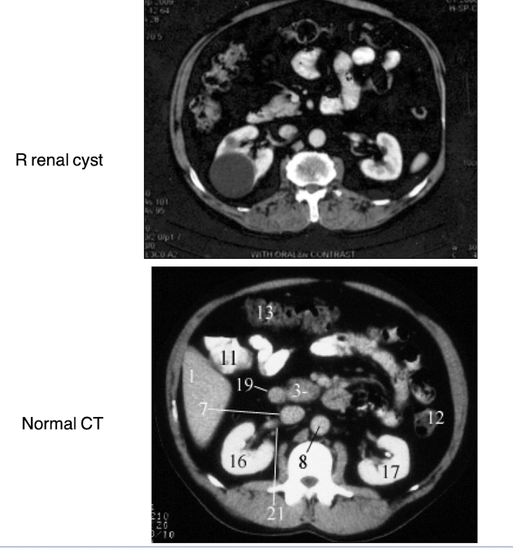 <p>Renal cysts are typically simple, fluid-filled sacs that are asymptomatic and have thin walls, while renal carcinoma presents as a solid mass with irregular borders and may show enhancement on imaging studies. Cysts appear anechoic on ultrasound, whereas carcinomas are often hypoechoic and may display vascularity on Doppler imaging. </p>