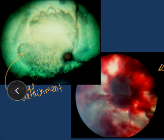 <p>Progression of CRF</p>