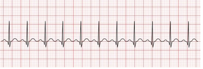 <ul><li><p class=""><strong>Rate</strong>: Greater than 100 bpm in the adult (ventricular and atrial)</p></li><li><p class=""><strong>Rhythm</strong>: Regular</p></li><li><p class=""><strong>P Waves</strong>: Normal and consistent, in front of the QRS</p></li><li><p class=""><strong>P to QRS Ratio</strong>: 1:1</p></li><li><p class=""><strong>PR Interval</strong>: Consistent, between 0.12 and 0.20 seconds</p></li><li><p class=""><strong>QRS Complex</strong>: Less than 0.12 seconds</p></li></ul><p></p>