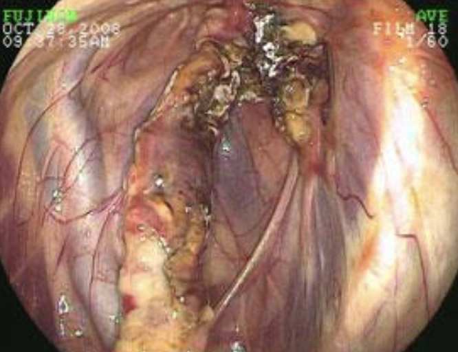 <p>fungal infection in the guttural pouch, can spread to the roof of the medial compartment and cause erosion of the internal carotid artery--> epistaxis</p>