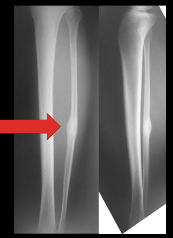 <p>increases</p><p>(later excess bone is re-absorbed as bone returns to normal strength)</p>