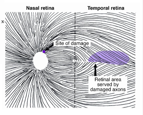 <p>Nasal step</p><p>Assymetric involvement of superior and imferior field </p>