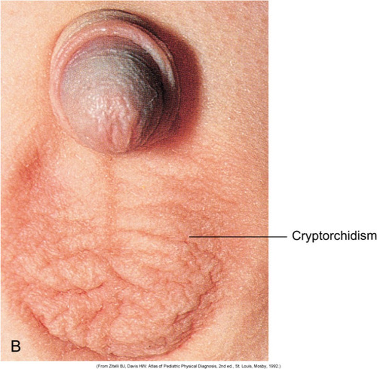 <p>undescended testicles</p>