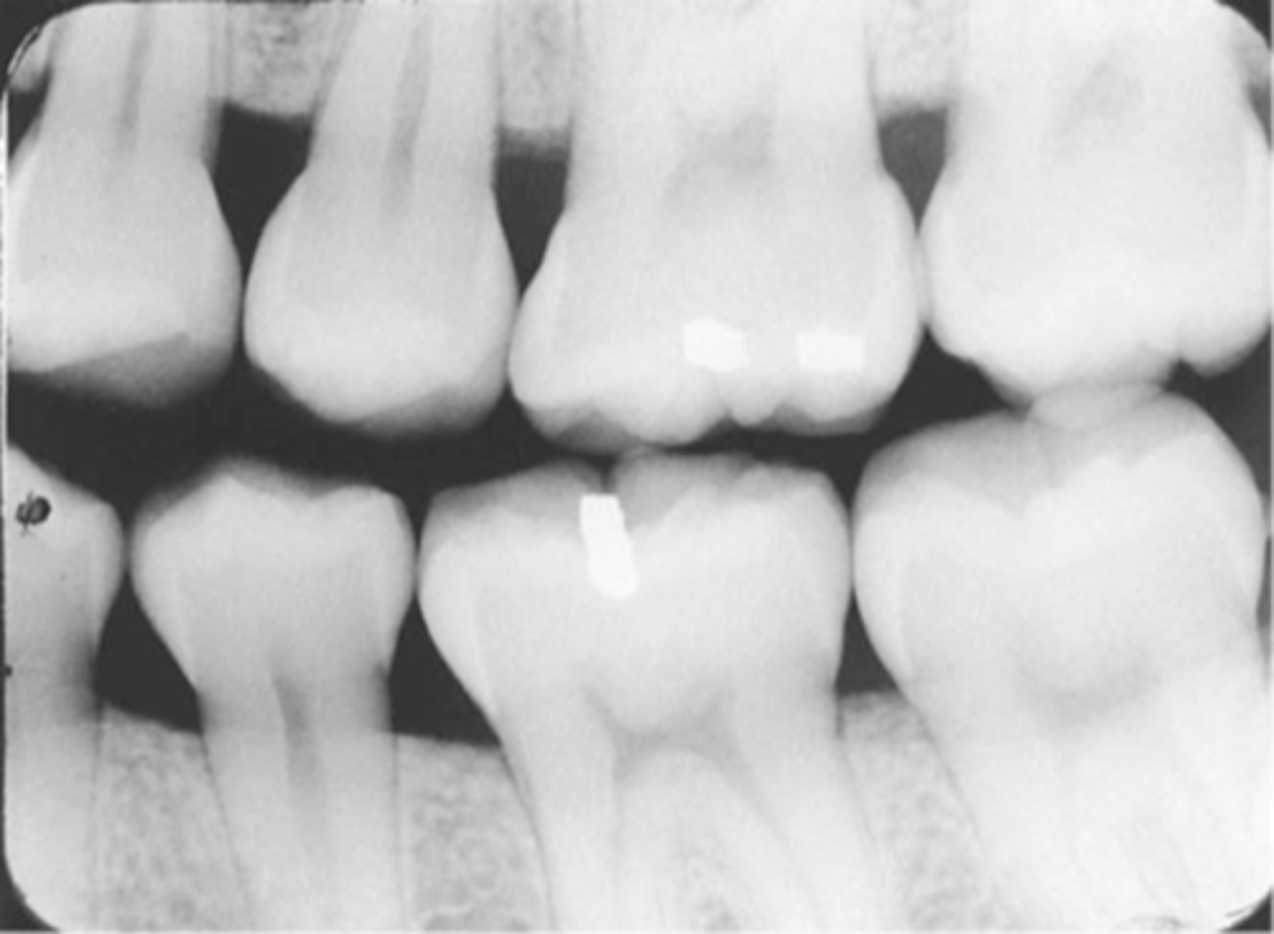 <p>-Distal surfaces of canines are not visible on the image</p><p>-Receptor was positioned too far posteriorly in the mouth; front edge of the receptor was not placed at the midline of the mand. canine.</p>