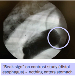 <p><span style="background-color: transparent;"><strong><span>Achalasia-like Syndrome</span></strong></span></p>