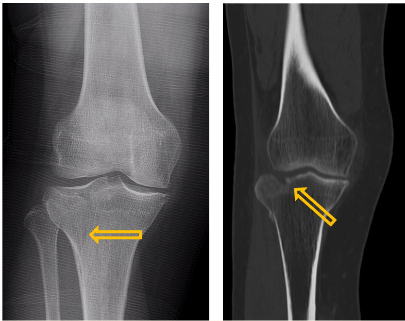 <p>Patient history: knee trauma </p><p>Modality: left image – AP knee radiograph; right image – noncontrast CT, coronal plane </p><p>Region: right knee </p><p>Radiologic sign: radiolucent fracture lines, interruption of the anatomic continuity of bone cortex </p><p>Diagnosis: acute fracture of tibial plateau</p>