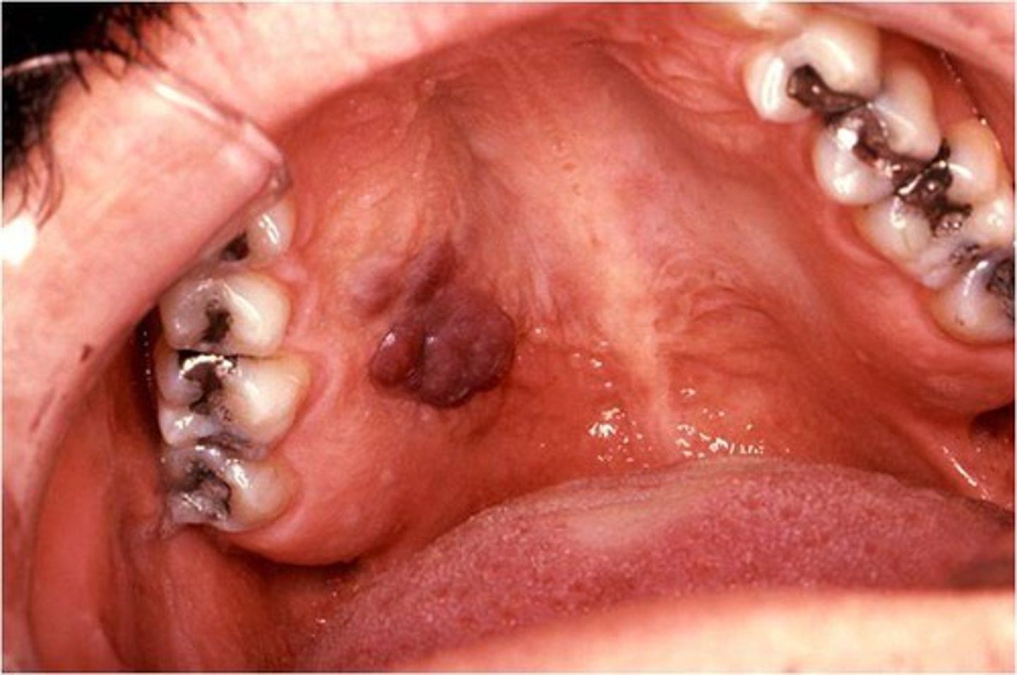 <p>kaposi sarcoma</p><p>hard palate</p><p>tx: provide normal dntal treatment but NO invasive treatment</p>