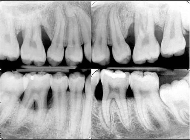 <p>Vertical Bone loss in stage IV periodontitis</p>