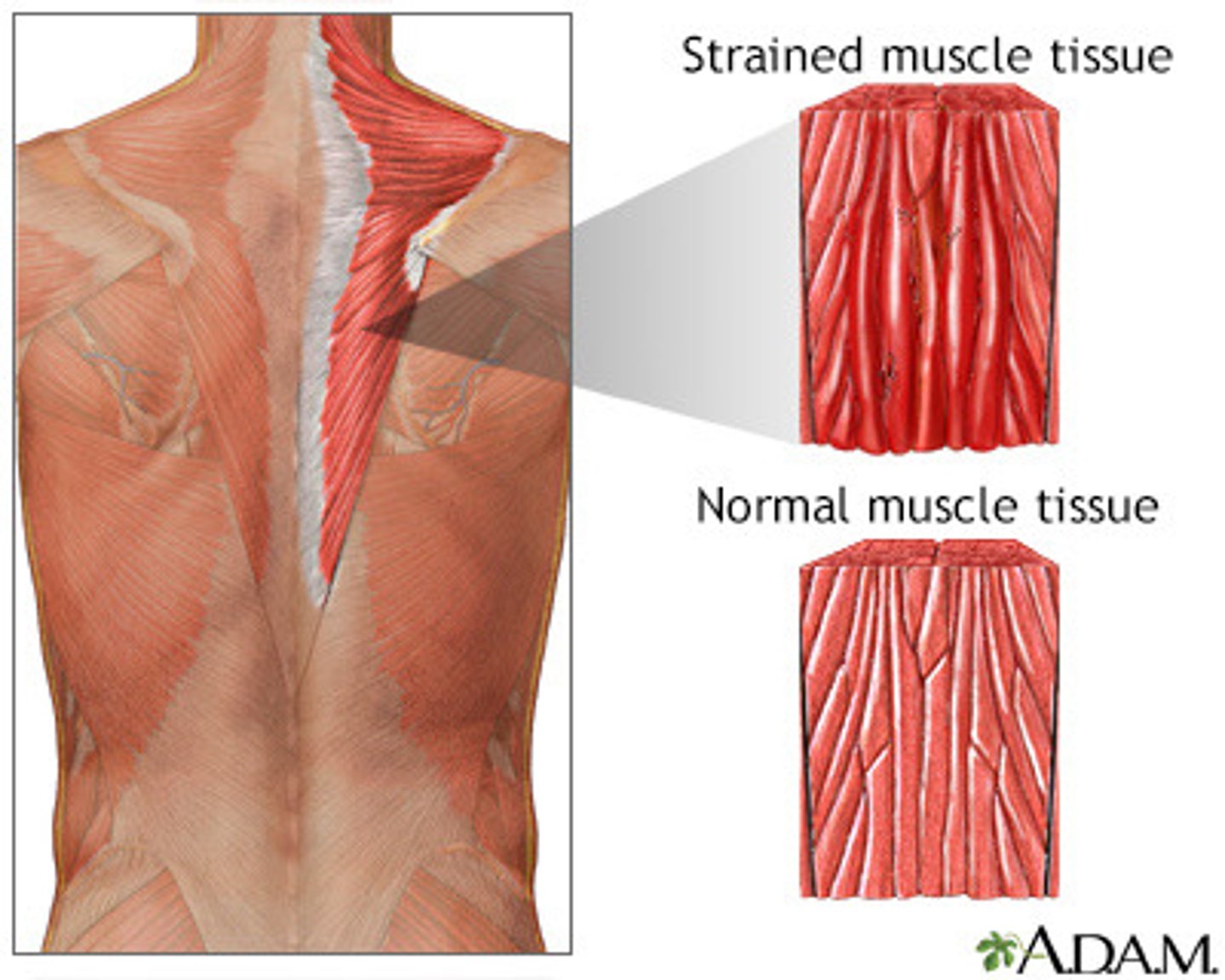 <p>- muscles: lower back or c-spine</p><p>- joints: elbow or shoulder</p><p>- tendon tear: achilles tendon, bicep tendon (tendon inflammation is usually chronic in nature)</p>