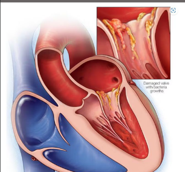 <p>Endocarditis is a life-threatening condition that occurs</p><p>when the endocardium becomes inflamed</p><p>Bacterial germs get into the bloodstream and attach to</p><p>damaged areas in the heart</p><p>Without quick treatment, endocarditis can damage or</p><p>destroy the heart valves</p><p>Treatments for endocarditis include medications and</p><p>surgery</p>