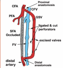 <p>CFA to distal PTA</p><p>bypass fem-pop occlusion</p><p>*use GSV &amp; remove valves; cut perforators</p><p>*connect prox v to CFA &amp; distal v to PTA</p>