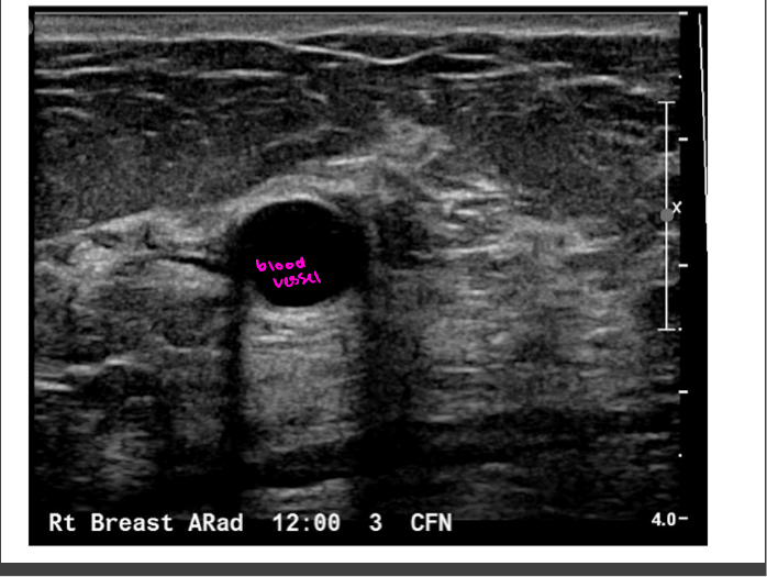 <p>no echos</p><p>Bladder, cystic fluid, gallbladder</p>