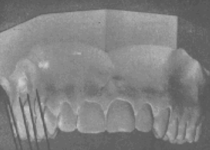 <p><strong>minus</strong> crown inclination existed in each crown from the upper canine through the upper second premolar</p>