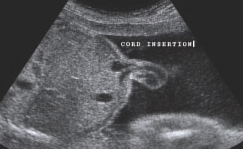 <ul><li><p>Vessels can be visualized as they <strong>enter</strong> <span style="color: rgb(0, 118, 255);">fetal abdomen</span></p></li><li><p>assess w/ color and 2D</p></li><li><p><span style="color: rgb(255, 0, 0);">2 arteries and 1 vein (Mickey Mouse Sign)</span></p></li><li><p>Be sure both arteries can be visualized coursing around fetal bladder <u>(confirms 3vc)</u></p></li><li><p>Be sure abdominal wall is intact at the area of the cord insertion</p></li></ul><p></p>