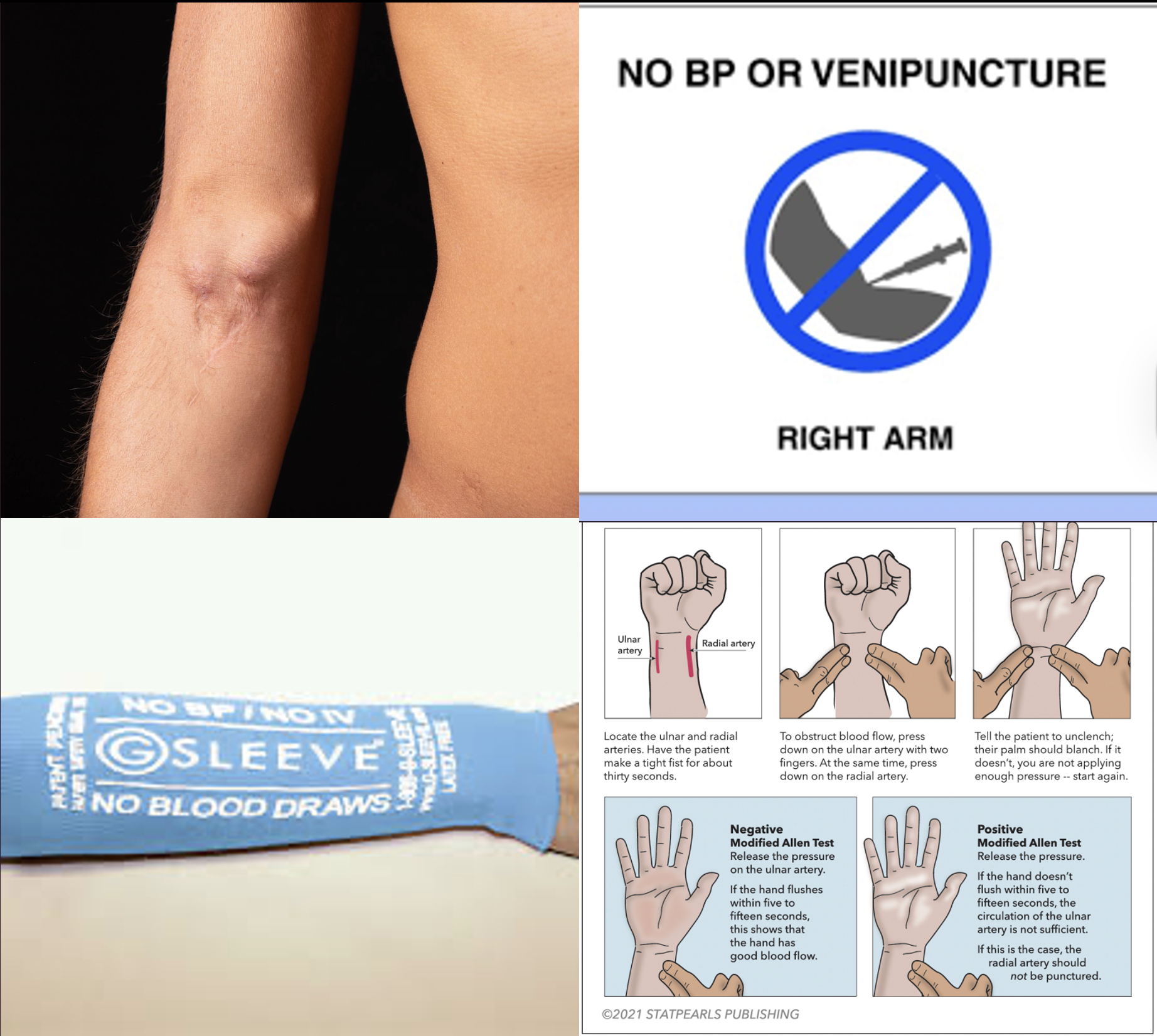 <p>What are some considerations when selecting an IV and ABG draw site?</p>