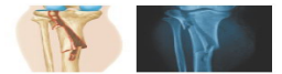 <p>Fracture in which the bone is shattered into multiple fragments; difficult to repair</p><p>(An illustration and an X ray of a comminuted fracture in the lower leg.)</p>