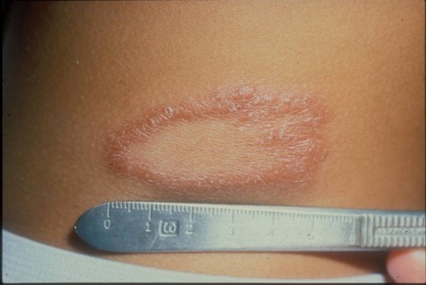 <p>caused by slow-growing bacteria called Mycobacterium leprae and Mycobacterium lepromatosis</p><p>the disease can affect the nerves, skin, eyes, and lining of the nose</p><p>in some cases, body parts may lose their sense of touch and pain, increasing the likelihood of injuries such as cuts and burn</p>