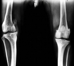 <p>Is this a medial or lateral patellar luxation?</p>