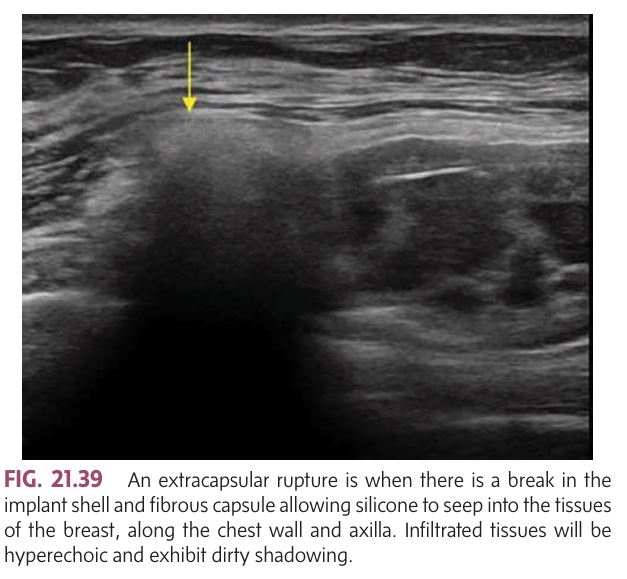 <p>Extracapsular Rupture: The most classic sonographic appearance is the ________ or echogenic noise. Infiltrated tissues will be hyperechoic and exhibit dirty shadowing</p>