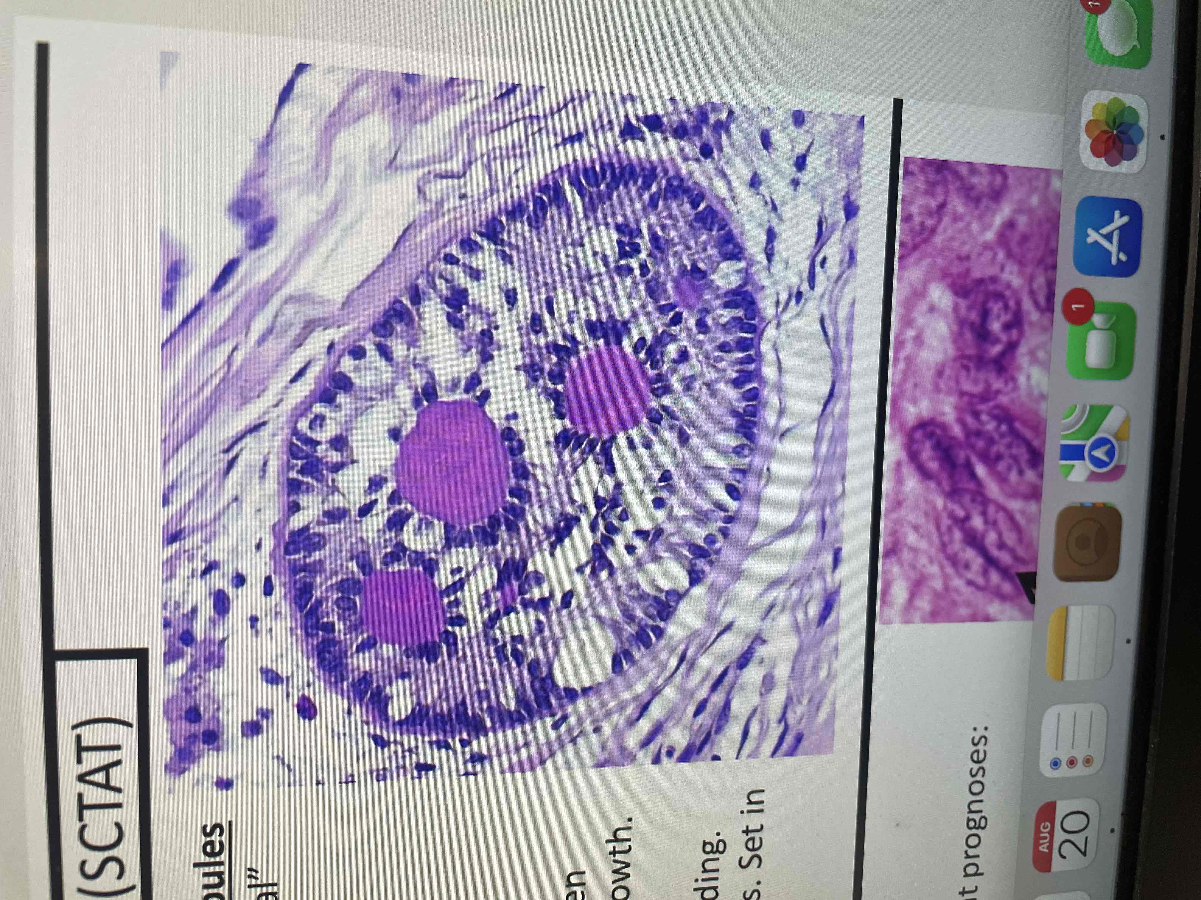 <p>Composed of aggregates of simple or complex annular tubules Cells are columnar with clear cytoplasm with an “antipodal” arrangement of the nuclei (at opposite ends) Hyaline basement membrane-like material within nests</p>