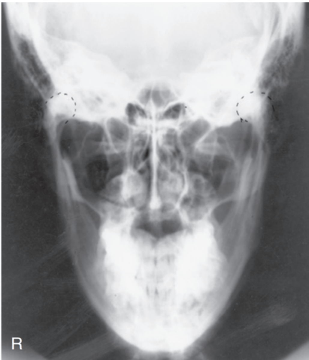 <p>-Position:</p><p>• No patient rotation exists, as indicated by mandibular rami visualized symmetrically, lateral to the cervical spine.</p><p>• Midbody and mentum are faintly visualized, superimposed on cervical spine.</p>