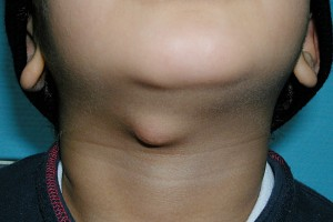 <p>midline neck mass at level of thyrohyoid membrane, associated w hyoid bone</p><p>sinus tract may be present</p>