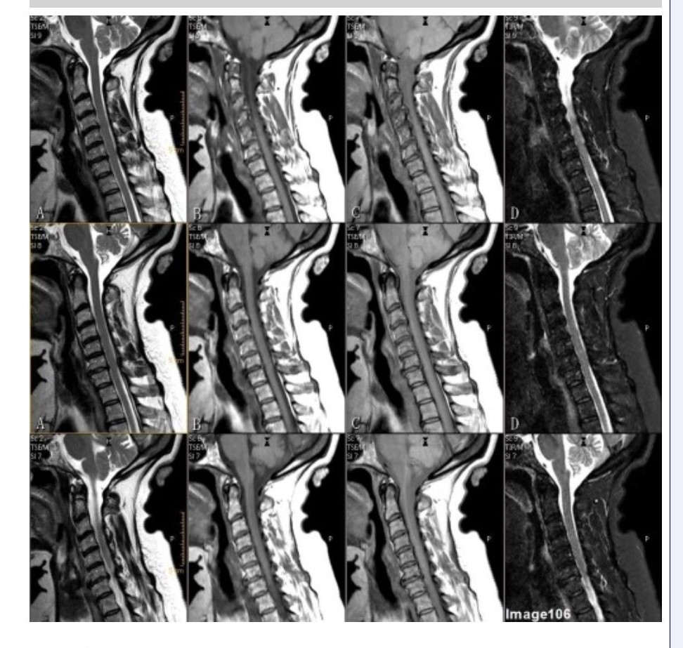 <p><span>Column B in Image 106 corresponds to which MRI pulse sequence?</span></p><p><span>&nbsp;A. Proton density</span></p><p><span>&nbsp;B. T1 weighted</span></p><p><span>&nbsp;C. T2 weighted</span></p><p><span>&nbsp;D. T2 FLAIR</span></p><p><span>&nbsp;E. STIR</span></p>