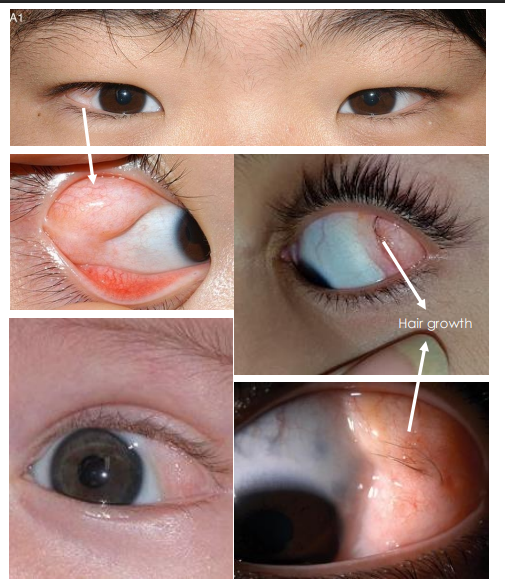 <p>• Less defined than dermoid, pale -white, soft <strong><u>“fatty” lesions </u></strong>fixed to the conjunctiva </p><p><u>• Can have fine hairs</u></p><p> • Location: Often at <strong><u>superotemporal fornix</u></strong></p>
