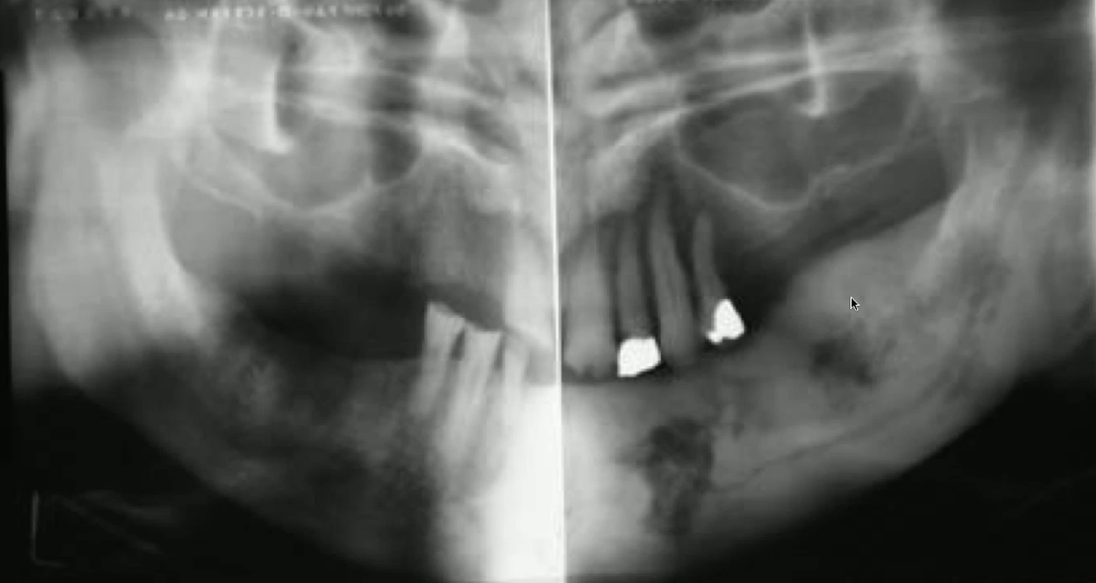 <p>what is the likely diagnosis of the lesion in the left mandibule</p>