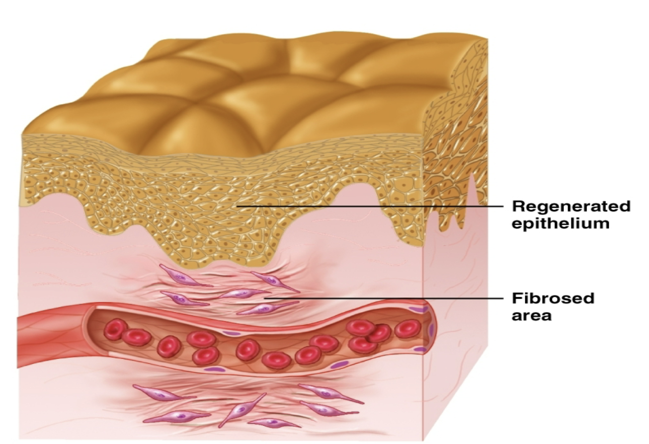 <p>fibrosis, surface epithelia replaced, fibrous layer contracts</p>