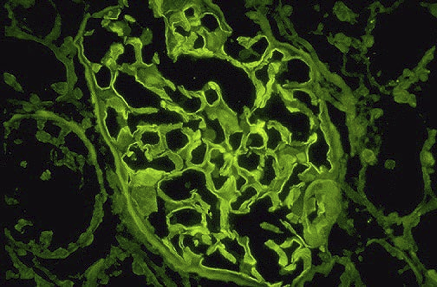<p>This stain is from what disease</p>