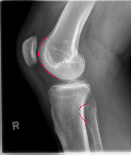 <p>good 90 OBL</p><ul><li><p>MAIN:</p><ul><li><p>ant. aspects of fem condyles SI ant/post</p></li><li><p>open pat-fem joint</p></li></ul></li><li><p>SUPPORTING:</p><ul><li><p>½ fib head SI</p></li></ul></li></ul><p></p>