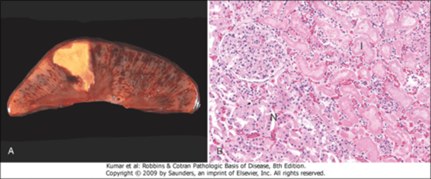 <p>necrosis of a localized area (caused by ischemia), can lead to coagulative necrosis</p><p>in this pick note the pink anucleate cells characteristic of coagulative necrosis</p>