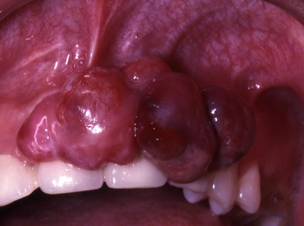 <p>What is the treatment of osteosarcoma?</p>